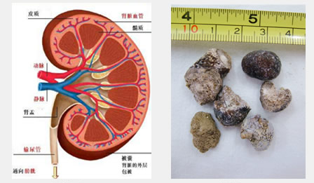 泌尿结石的治疗