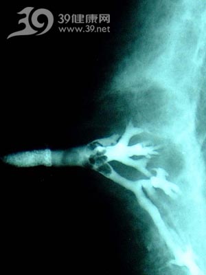 立体乳腺造影突破漏诊门槛