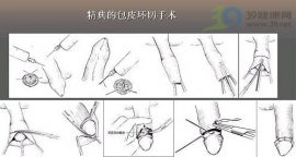 包皮环切手术的方式