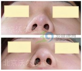 专家来稿：几例鼻矫正案例分析