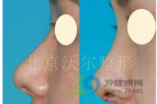 专家来稿:几例鼻矫正案例分析