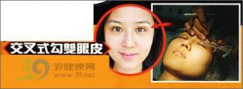 袁弥明代言“交叉勾双眼皮” 专家揭真相