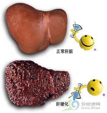 乙肝患者怎样早发现肝硬化