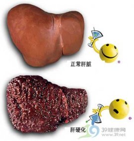 乙肝患者怎样早发现肝硬化