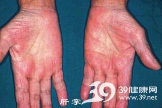 乙肝患者怎样早发现肝硬化