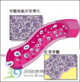 面对血癌奇迹是这样出现的