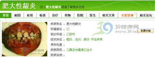 综合认识牙龈炎