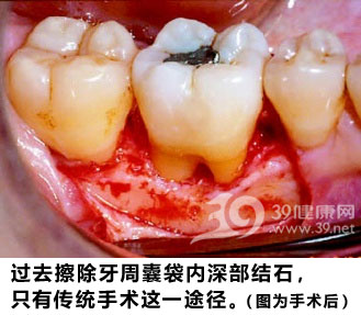 恐怖牙结石 无声无息的牙齿杀手