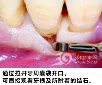 恐怖牙结石 无声无息的牙齿杀手