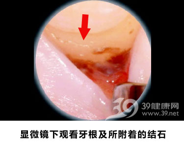 恐怖牙结石 无声无息的牙齿杀手
