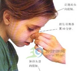 流鼻血莫仰头