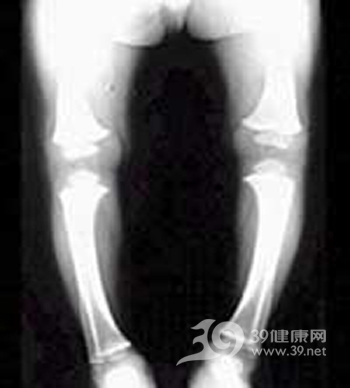 佝偻