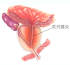 前列腺囊肿