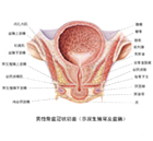 前列腺钙化