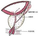精囊炎