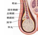 精索静脉曲张